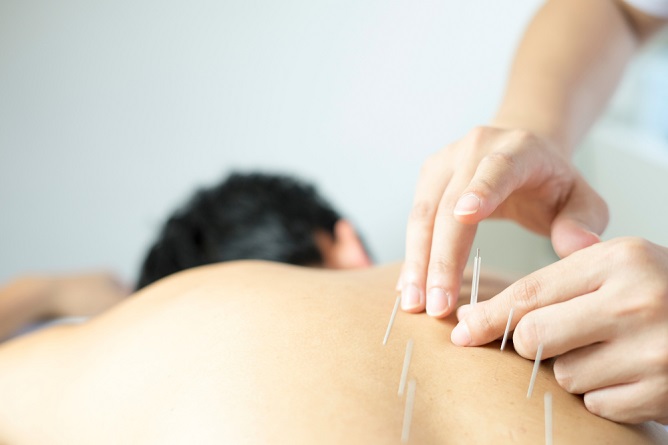 reasons-to-try-undergoing-acupuncture